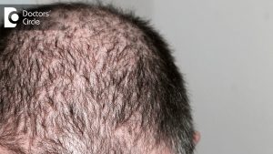 Read more about the article Minoxidil for hair loss – Dr. K Prapanna Arya