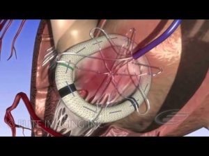 Mitral Heart Valve Ring – Medical & Scientific Video Production