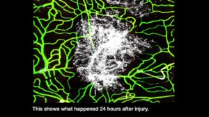 Brain Injury Medicine Video – 1