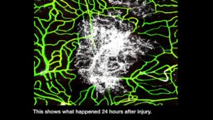 Read more about the article Brain Injury Medicine Video – 1