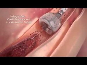 Newest Technology | Heart Stent video (Angioplasty) New Medical Line Video | Heart Attack reasons