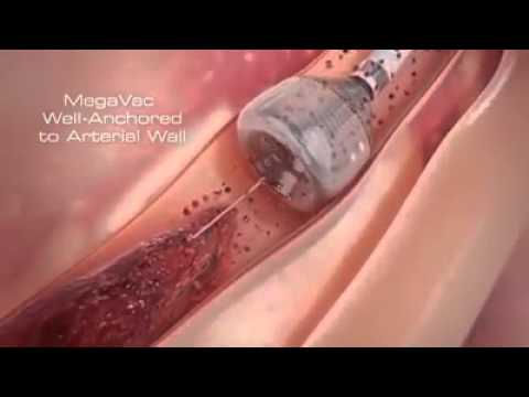 You are currently viewing Newest Technology | Heart Stent video (Angioplasty) New Medical Line Video | Heart Attack reasons