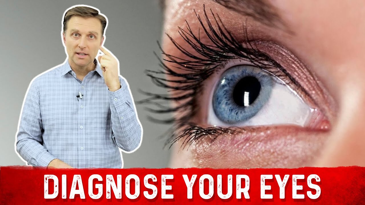 You are currently viewing Nutritional Deficiency Symptoms From Eyes | Dr.Berg