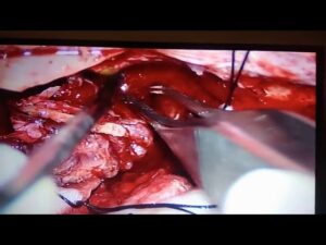 Onco Surgery Video – 5