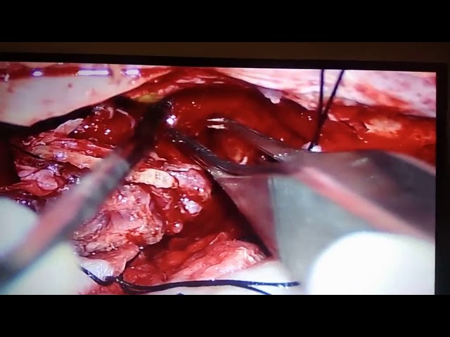 You are currently viewing Onco Surgery Video – 5