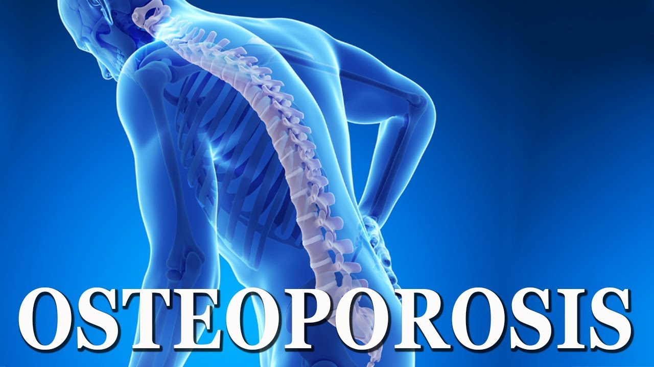 You are currently viewing Osteoporosis [Bone Disease] | Simple & Effective Natural Home Remedies for Osteoporosis & Arthritis
