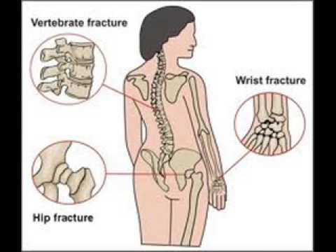 You are currently viewing Osteoporosis Signs Symptoms  INFECTION CONTROL , HEALTH EDUCATION , URDU / HINDI