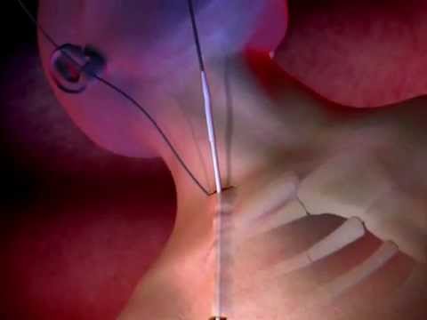 You are currently viewing ProGuide™ Chronic Dialysis Catheters Animation