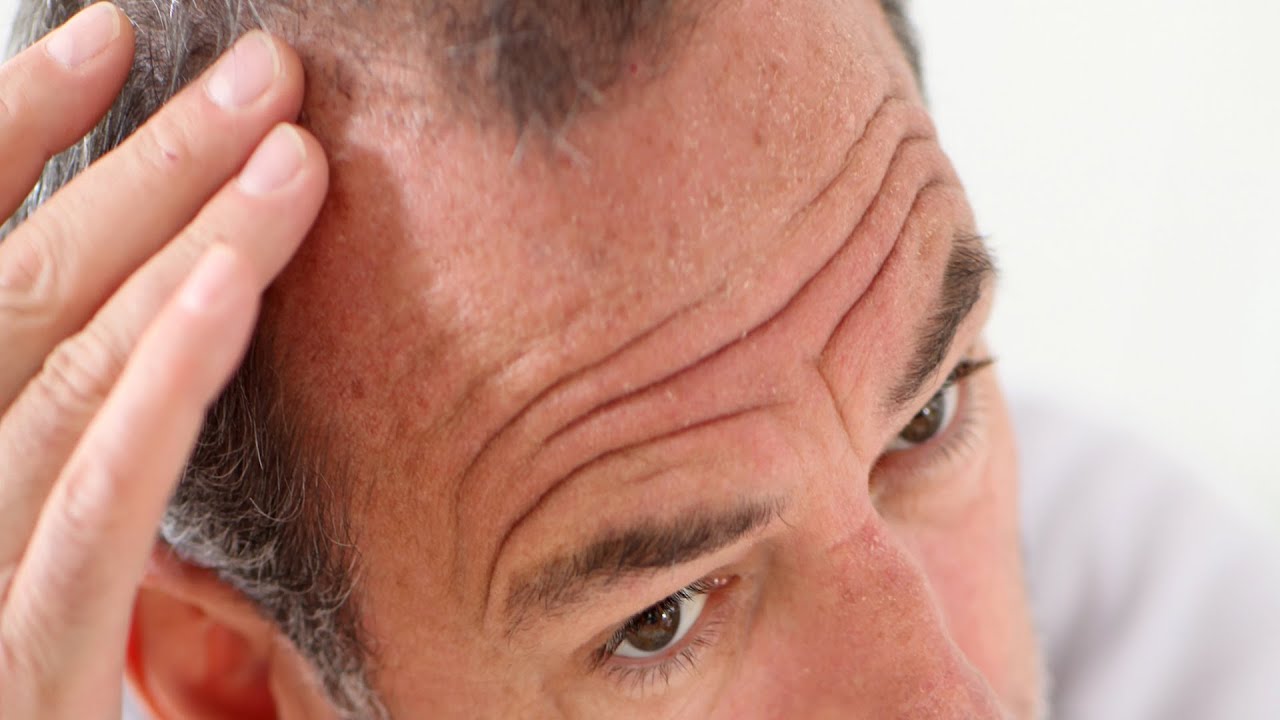 You are currently viewing Pros & Cons of Propecia (Finasteride) | Thinning Hair