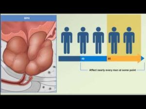 Read more about the article Prostate Enlargement: Benign Prostatic Hyperplasia – BPH Causes, Symptoms, Treatment Animation Video