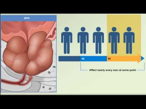 You are currently viewing Prostate Enlargement: Benign Prostatic Hyperplasia – BPH Causes, Symptoms, Treatment Animation Video