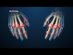 Rheumatology Video – 1