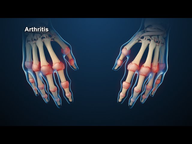 You are currently viewing Rheumatology Video – 1