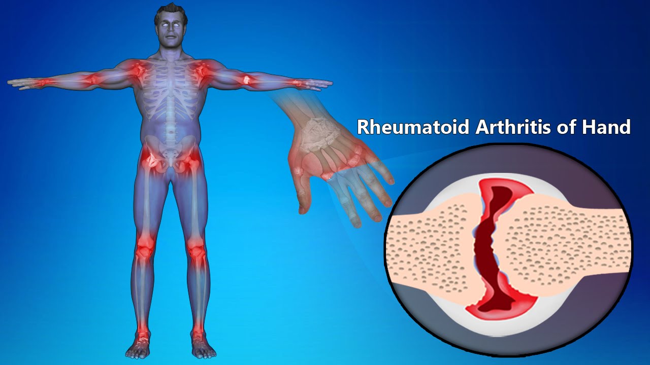 You are currently viewing Rheumatoid Arthritis Of Hands: Symptoms, Signs, Treatment