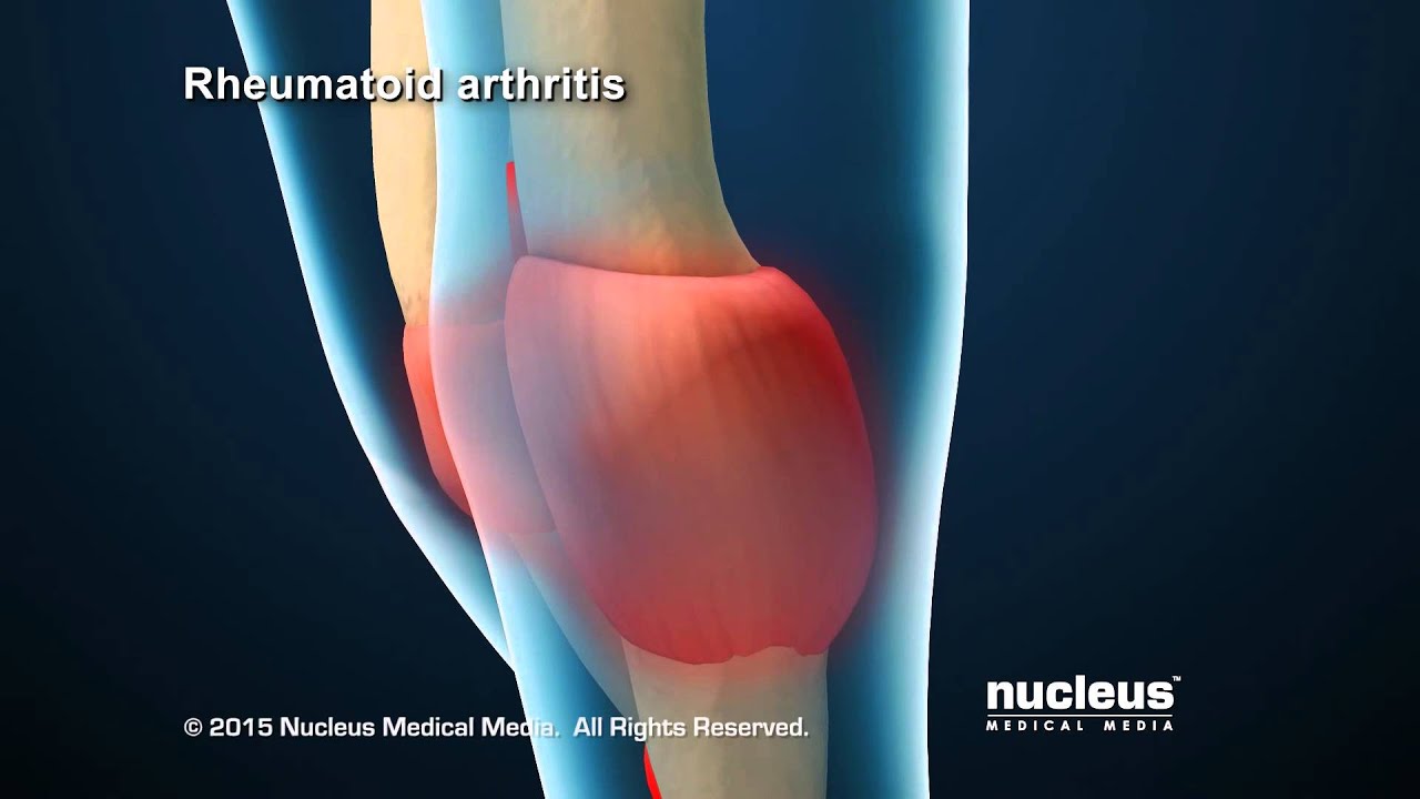 You are currently viewing Rheumatology Video – 3