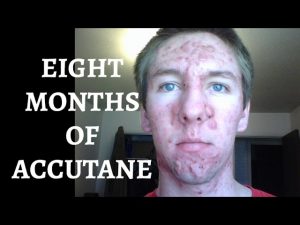 Read more about the article Severe Cystic Acne – Timelapse (Version 1)