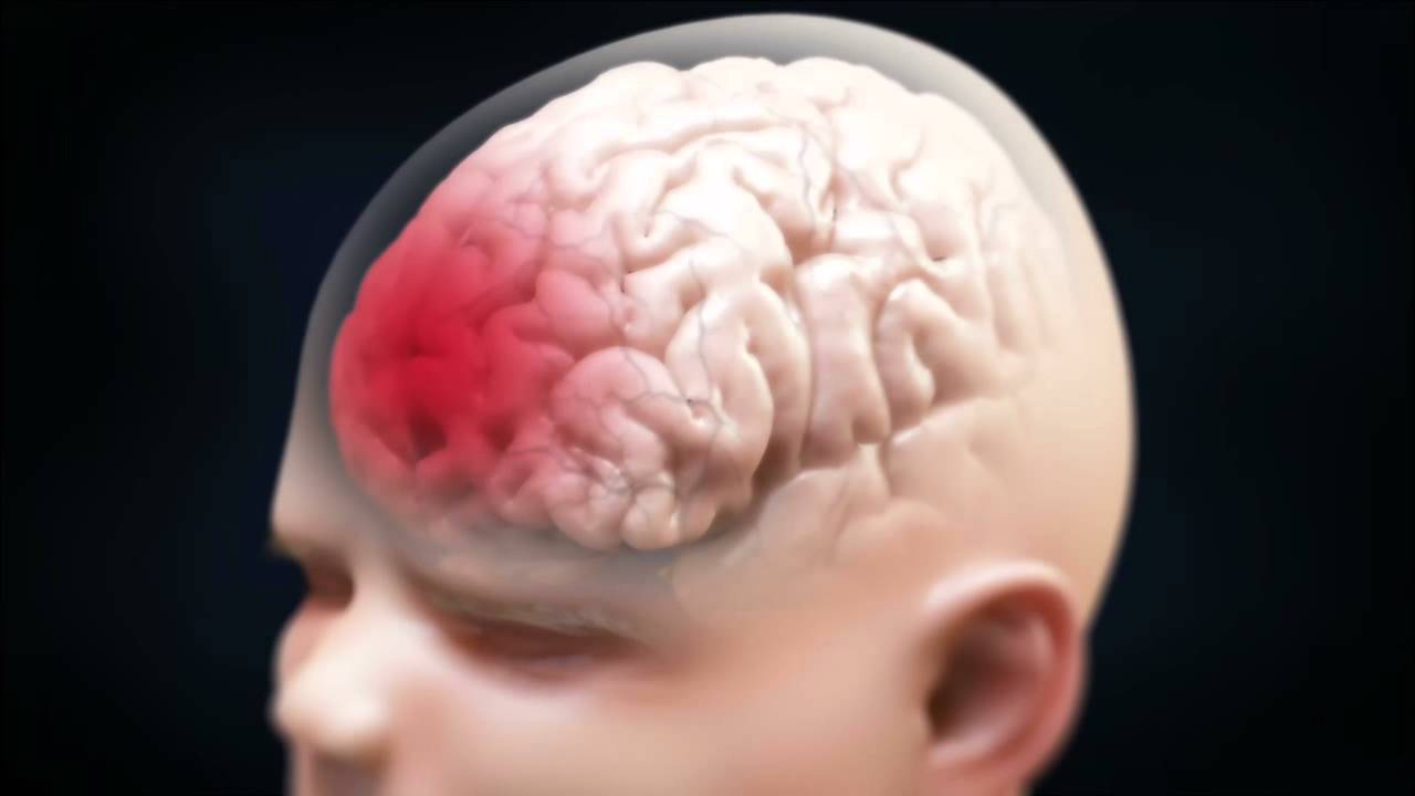 You are currently viewing Shaken Baby Syndrome Brain Injury