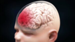 Read more about the article Shaken Baby Syndrome Brain Injury