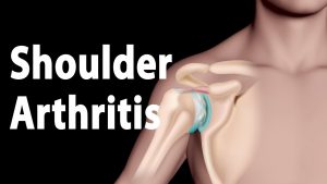 Shoulder Arthritis Narrated Animation.
