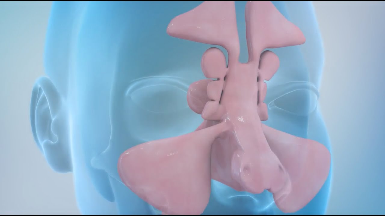 You are currently viewing Sinusitis and Sinus Surgery Explained (Balloon Sinuplasty and Endoscopic Sinus Surgery)