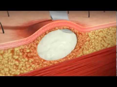 You are currently viewing Skin Abscess I&D Animation. Injectioncourses.com