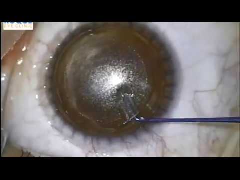 You are currently viewing Laser Surgeries Video – 3