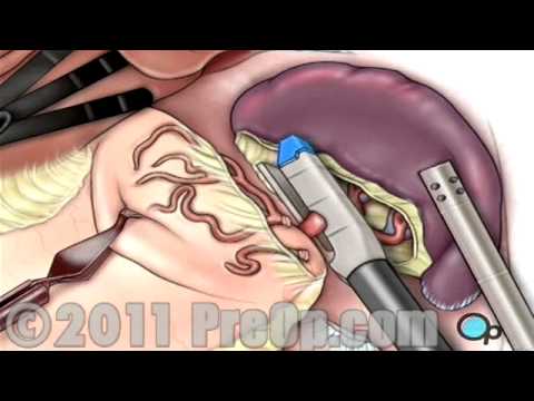 You are currently viewing Spleen Removal Surgery Laparoscopic Splenectomy PreOp® Patient Education