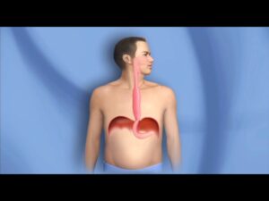 Onco Surgery Video – 3