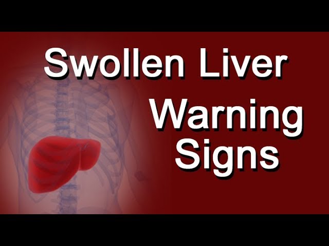 You are currently viewing Swollen Liver Warning Signs