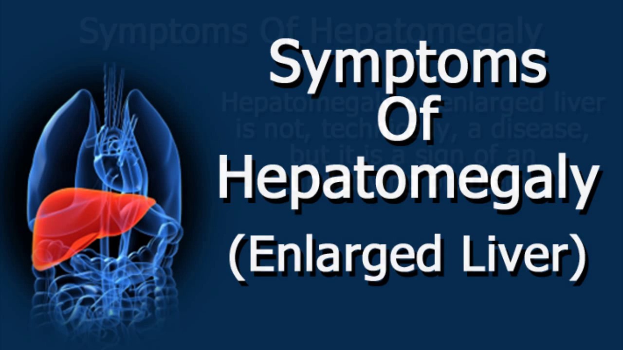 You are currently viewing Symptoms Of Hepatomegaly (Enlarged Liver)