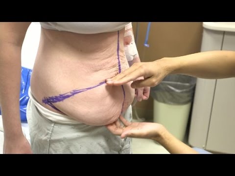 You are currently viewing Teen gets tummy tuck to remove ‘hang’