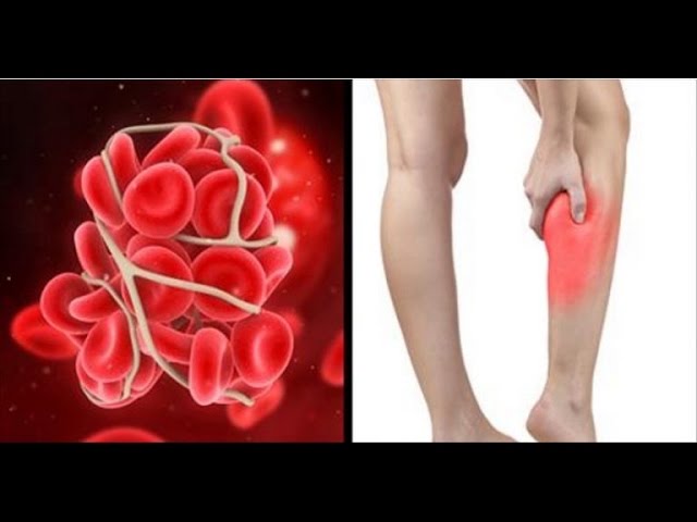 You are currently viewing These Are The Symptoms and Signs You May Have a Blood Clot in Your Leg