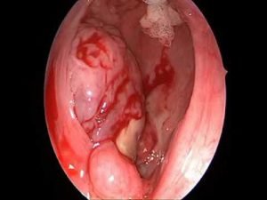 Tonsil Abscess (Pus Formed Within Infected Tonsil Tissue)