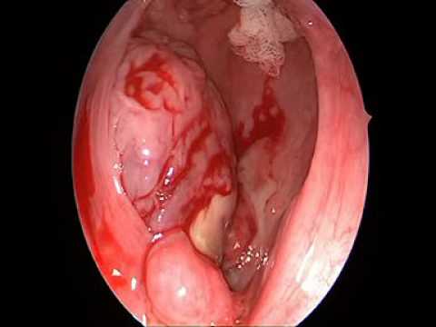 You are currently viewing Tonsil Abscess (Pus Formed Within Infected Tonsil Tissue)
