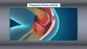 Read more about the article [Treatment] Treatment for Osteoarthritis of the Knee