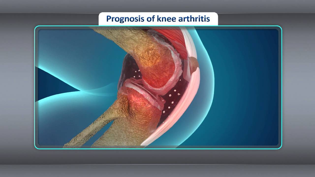 You are currently viewing [Treatment] Treatment for Osteoarthritis of the Knee
