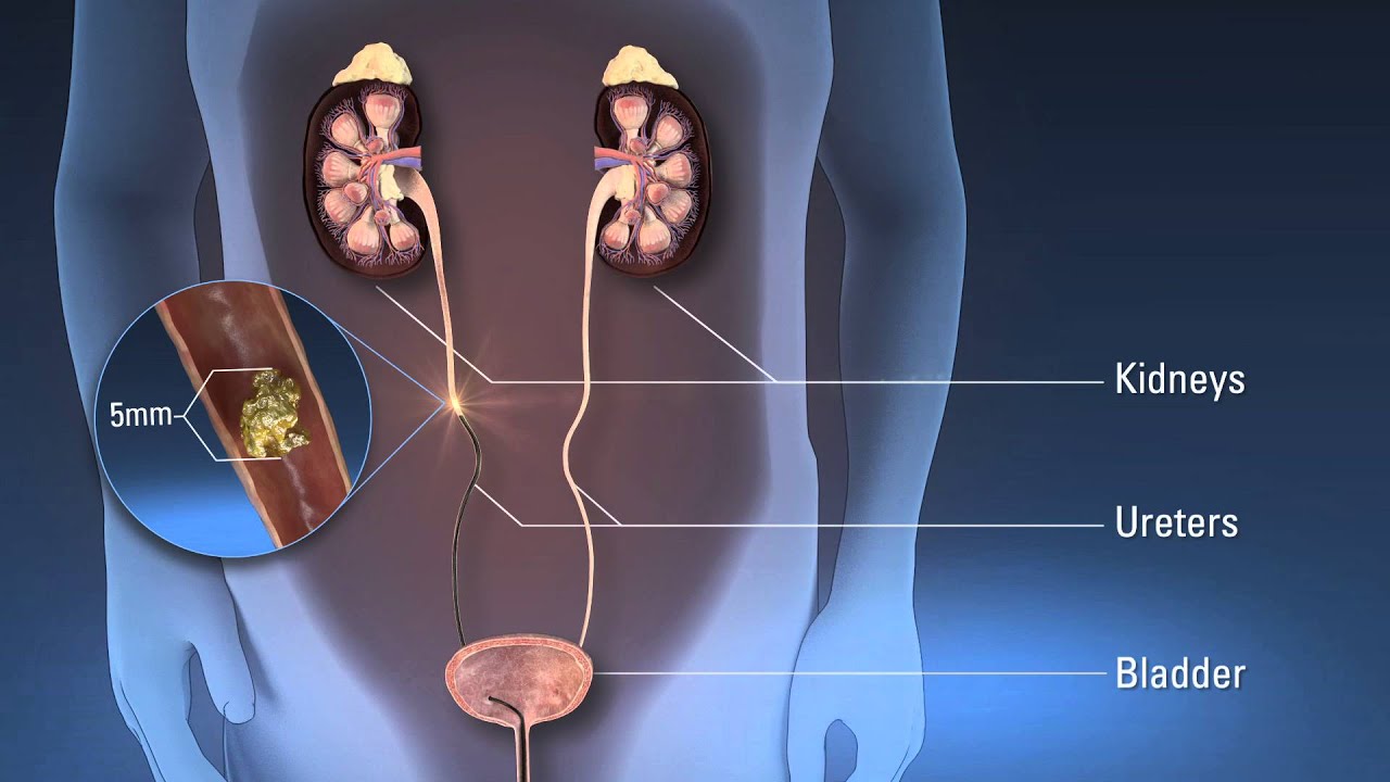You are currently viewing Nephrology Surgeries Video – 5