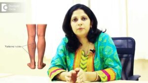 Read more about the article Varicose veins during pregnancy – Dr. Shweta Arora