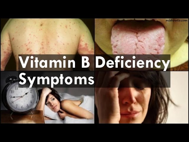 You are currently viewing Vitamin B Deficiency Symptoms