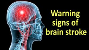 Warning Signs of Brain Stroke  || Health Tips