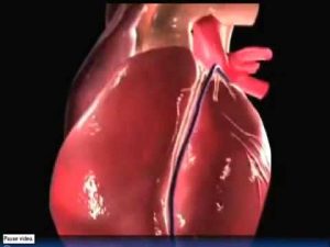 Read more about the article Watch Heart Attack in 3D