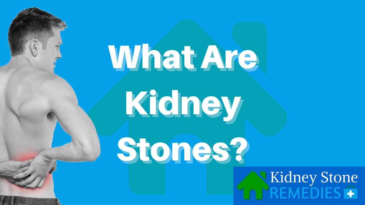 You are currently viewing What Are Kidney Stones – Kidney Stone Home Remedies