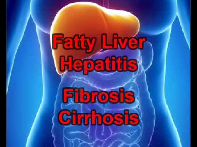 You are currently viewing What Are the Stages of Liver Damage? Fatty Liver|Hepatitis|Fibrosis|Cirrhosis