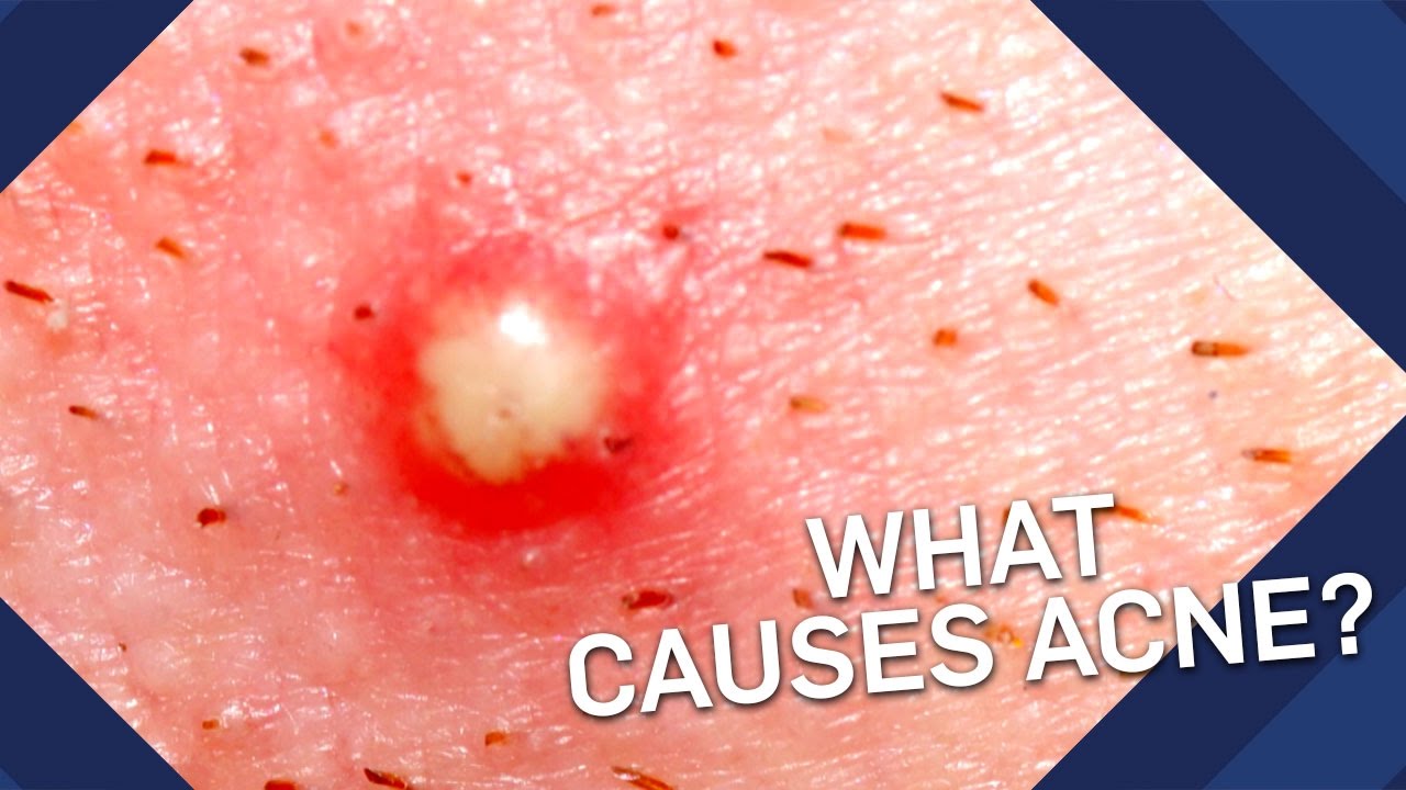 You are currently viewing What Causes Acne? | Brit Lab