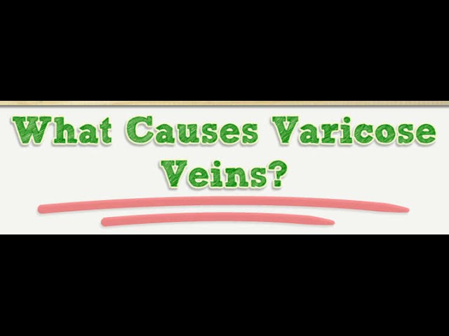 You are currently viewing What Causes Varicose Veins?