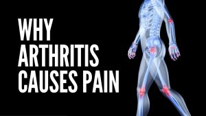 Read more about the article What Is Arthritis | What Causes Arthritis | Why Arthritis Causes Pain