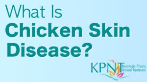 Read more about the article What Is Chicken Skin Disease Video