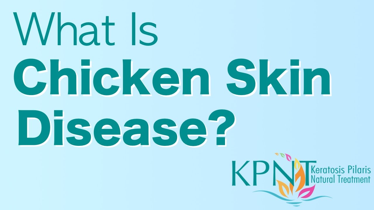 You are currently viewing What Is Chicken Skin Disease Video