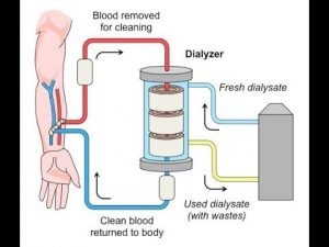 What Is Kidney Dialysis?