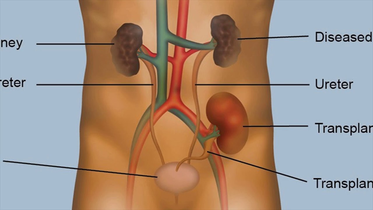 You are currently viewing What Is Kidney Transplantation – Benefits- Risks